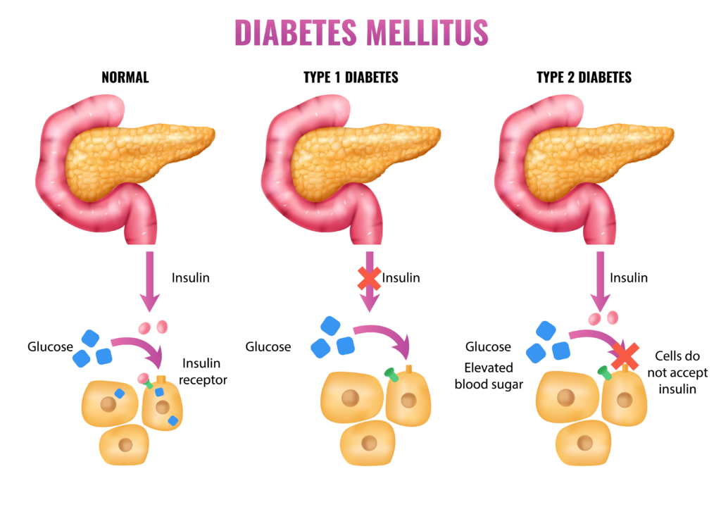 What is gestational diabetes​ ?